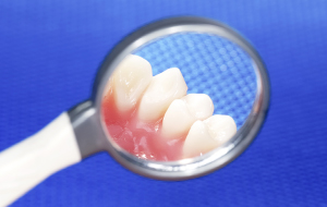 東長崎・とどデンタルクリニック・周囲の歯がむし歯、歯周病になりやすくなる
